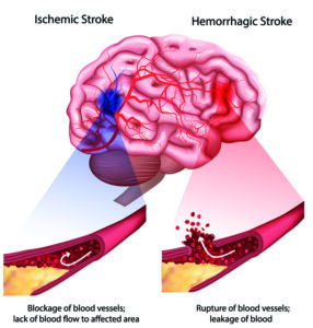 graphic showing the types of stroke
