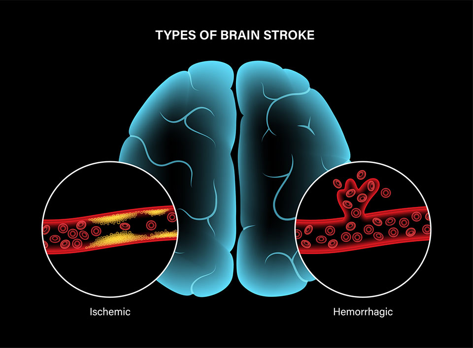 Brain stroke, hemorrhagic and ischemic problem. Arteriosclerosis, infarct, ischemia, thrombosis disease. High ldl and hdl level. Cholesterol in human blood vessels. Medical poster vector illustration.
